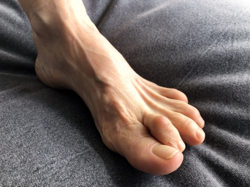 Foot wit hJoint Deformities