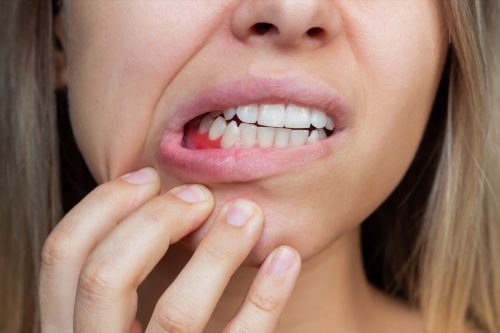 Woman with Beginnings of Gum Disease