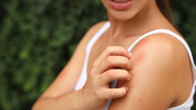 Woman outside scratching mosquito bites on her shoulder
