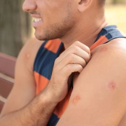 Man wearing a tank top sitting on a bench outside and scratching mosquito bites on his arm