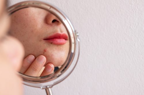 woman concerned about pimple looking in the mirror