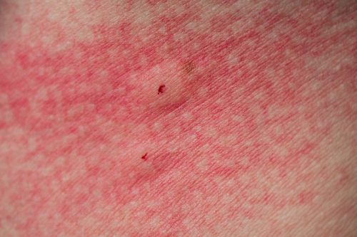 bite with a red rash on the skin close up