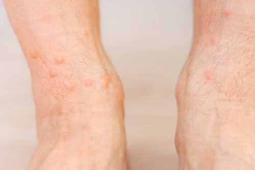 Close up allergic rash dermatitis eczema on man foot. Leg with red rash caused by insect bites. Dermatitis, folliculitis, fungal infection. Affected area of skin to turn red and blotchy and to swell.