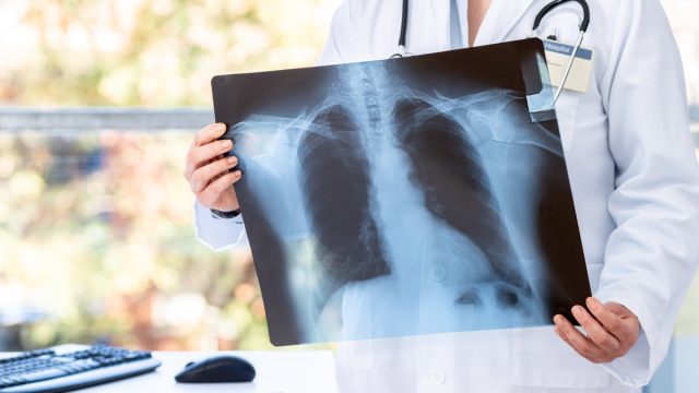 Doctor diagnosing patient’s health on asthma, lung disease, long COVID-19, coronavirus or bone cancer illness with radiological chest x-ray film for medical healthcare hospital service
