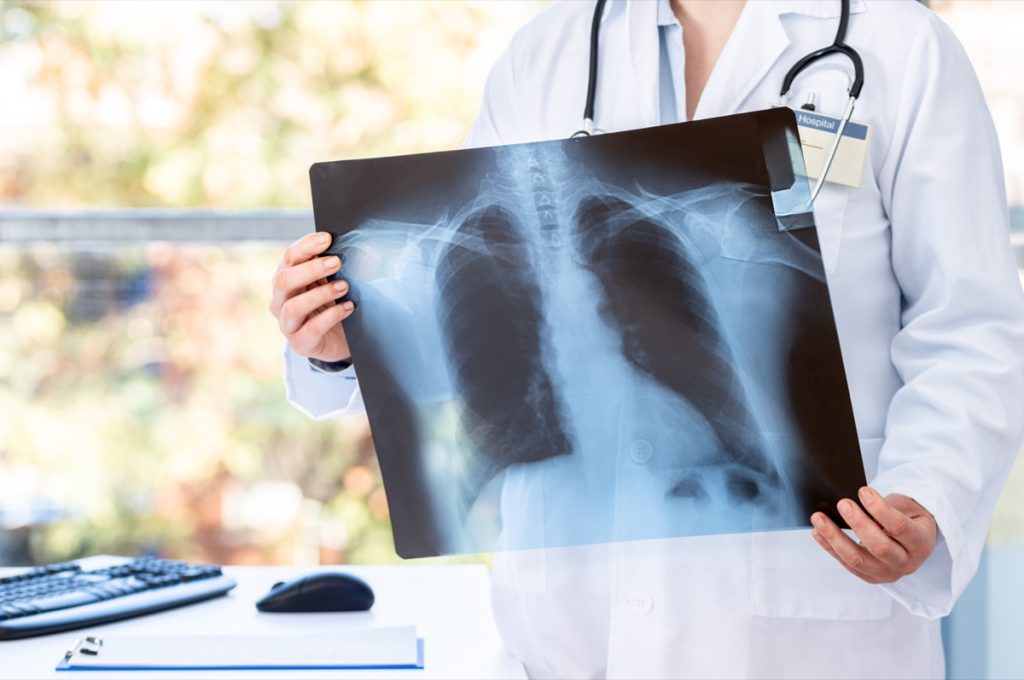 Doctor holding up radiological chest x-ray film 