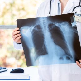Doctor diagnosing patient’s health on asthma, lung disease, long COVID-19, coronavirus or bone cancer illness with radiological chest x-ray film for medical healthcare hospital service