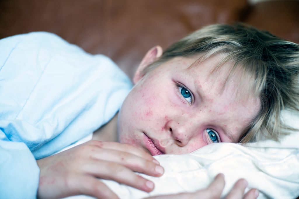 A young boy sick in bed with measles