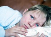 A young boy sick in bed with measles