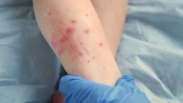 Doctor hands examining infant leg. Little Kid allergy. Closeup. Child scratches a red rash. Nurse applies a special cream to atopic skin. Dermatitis, diathesis, irritation on the baby body. Pruritus