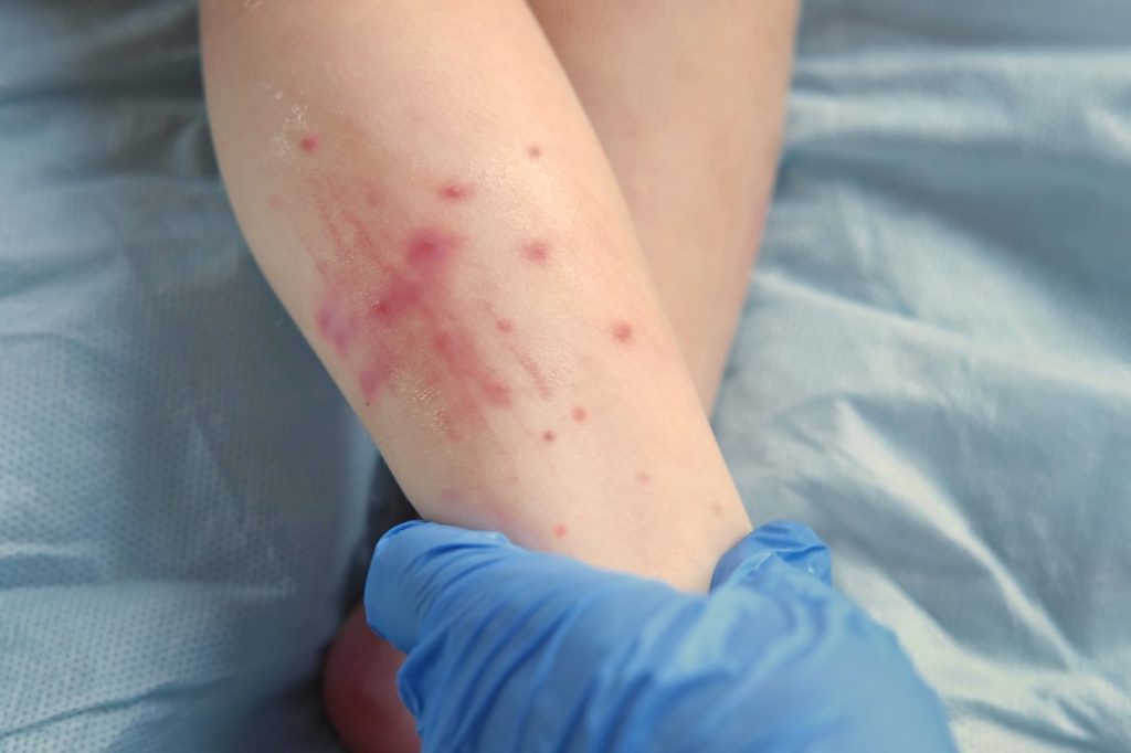 Doctor examining rash on child's leg