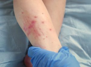 Doctor hands examining infant leg. Little Kid allergy. Closeup. Child scratches a red rash. Nurse applies a special cream to atopic skin. Dermatitis, diathesis, irritation on the baby body. Pruritus