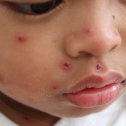 A close up of a baby's face with measles