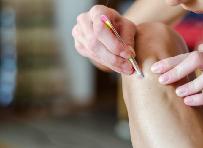 A close up of a person using tweezer to pick an ingrown hair from their leg