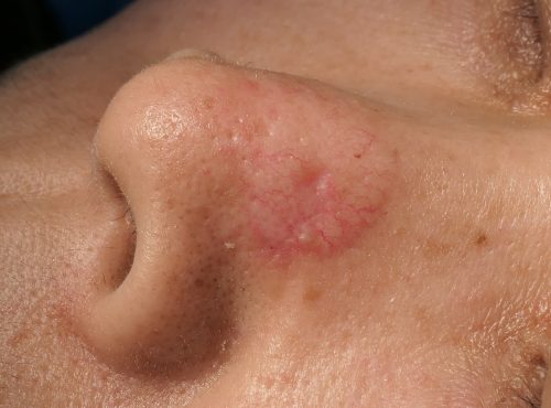 skin cancer with basal cell carcinoma on nose