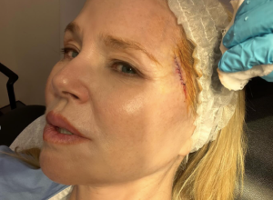 Christie Brinkley Instagram photo showing her skin cancer removal