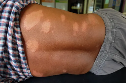 Leprosy, skin of the patient Leprosy , The white band on the back of the man
