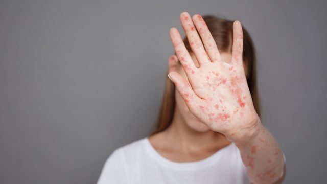 Stop Measles. Girl With Virus Closing Face From Camera Over Grey Background