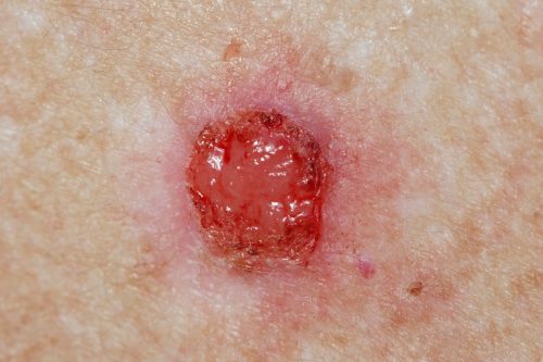 Open wound with weeping and bleeding caused by an untreated basal cell. Pre-treatment open wound requiring medical attention.