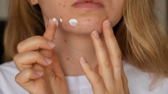 woman applying acne face cream