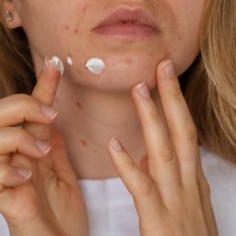 woman applying acne face cream