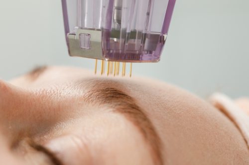 Closeup of a woman receiving microneedling rejuvenation treatment in her forehead