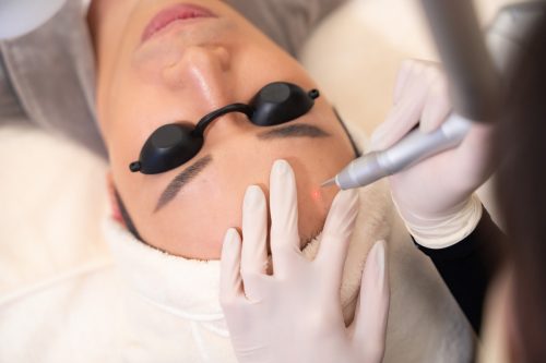 Closeup of a person wearing protective goggles receiving a laser skincare treatment on their forehead