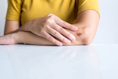 woman tapping fingers on arm