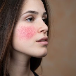 portrait of a young woman with rosacea