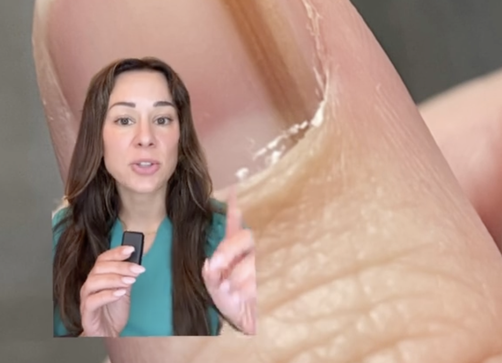 Still from a video of a dermatologist overlayed on a fingernail