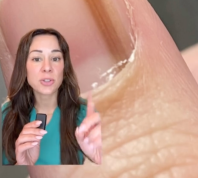 Still from a video of a dermatologist overlayed on a fingernail