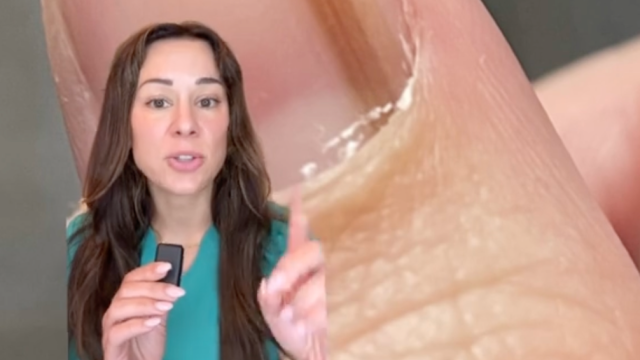 Still from a video of a dermatologist overlayed on a fingernail
