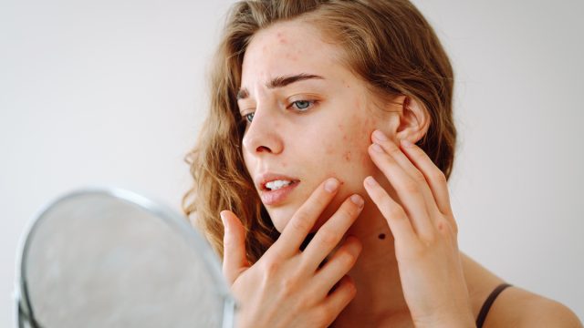 A woman looking in a mirror, touching her face, which is breaking out