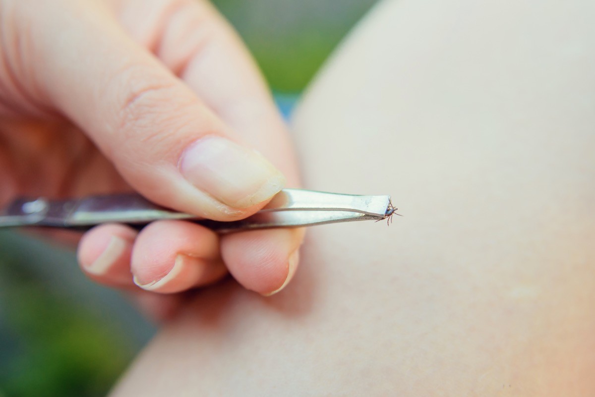 Removing a tick with tweezers