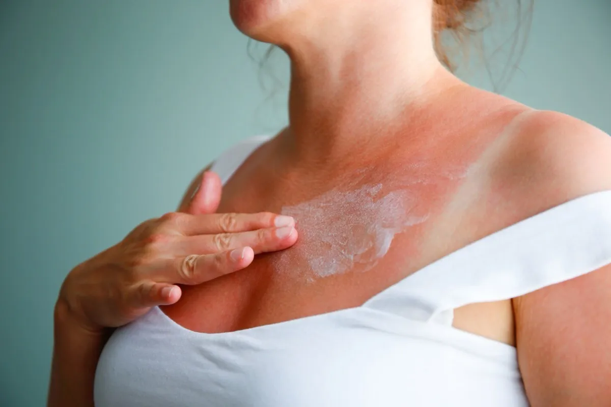 woman applying lotion to her sunburned chest