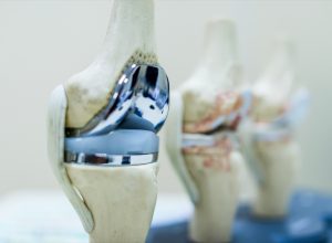 Can You Delay a Knee Replacement? New Treatment Approach May Eliminate Pain