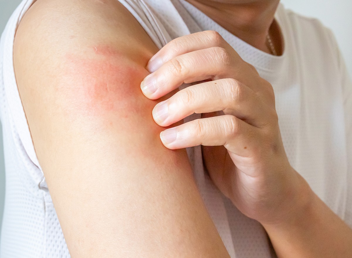 A man scratching his arm from allergic itchy eczema