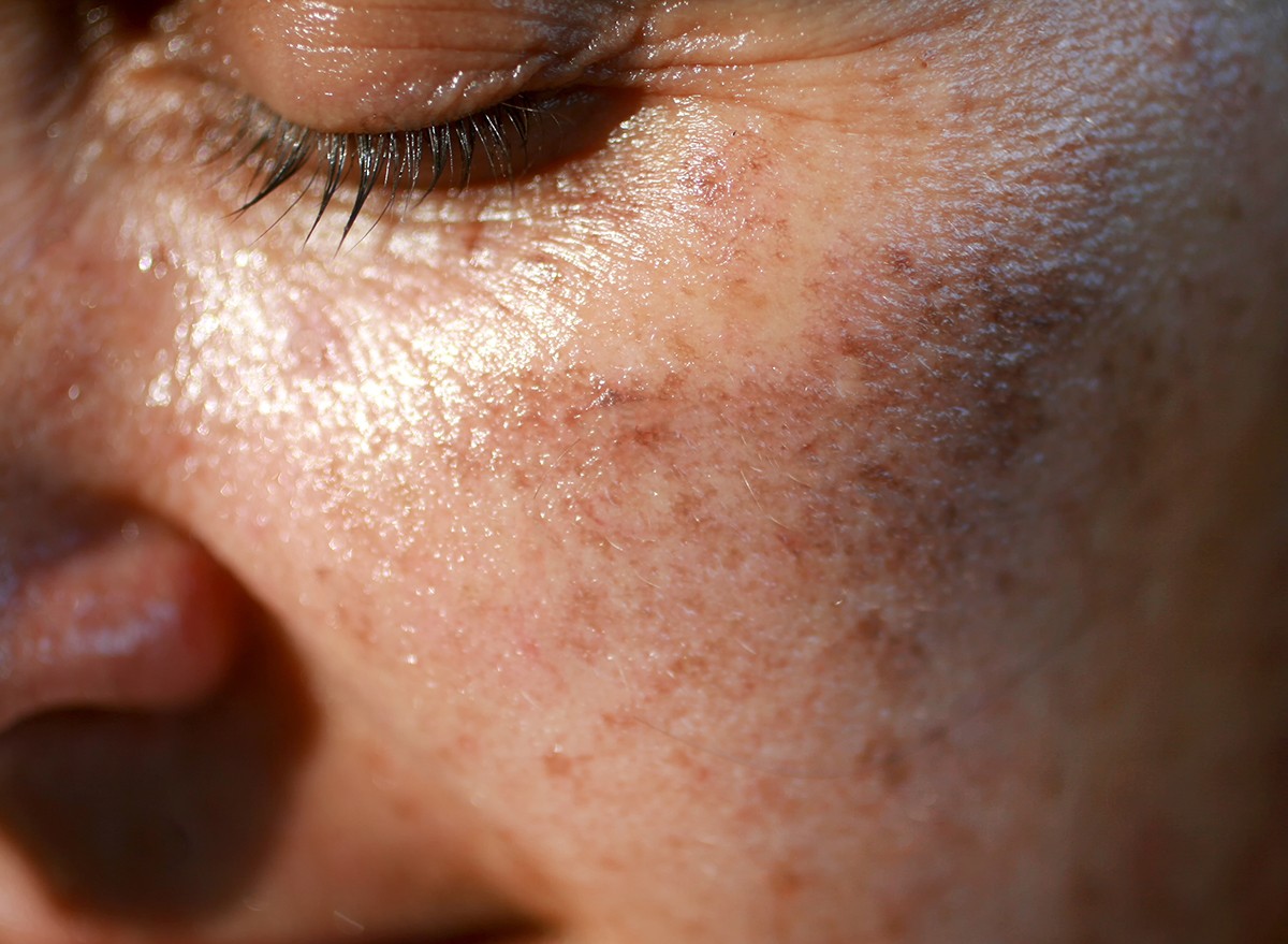 Pigmented spots from sun damage on a woman's face
