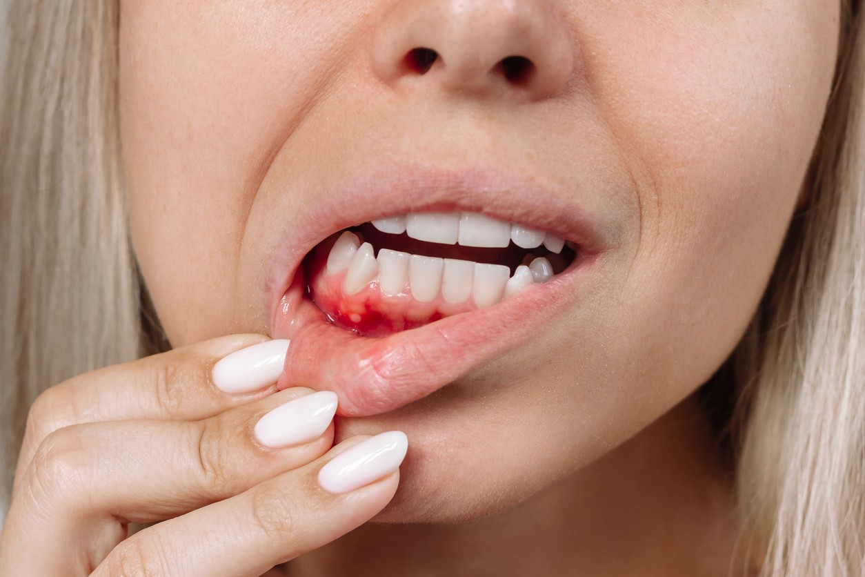 A woman with bleeding gums