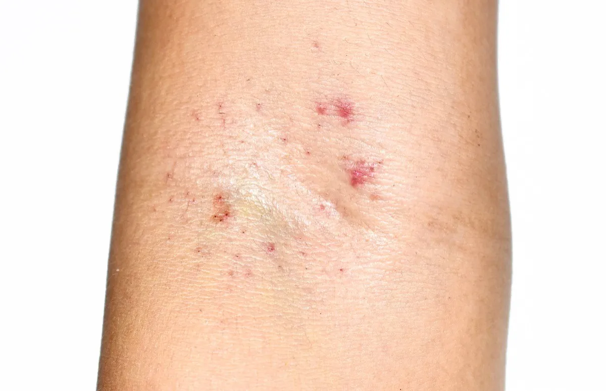 groups of red spots or petechiae on the inner elbow