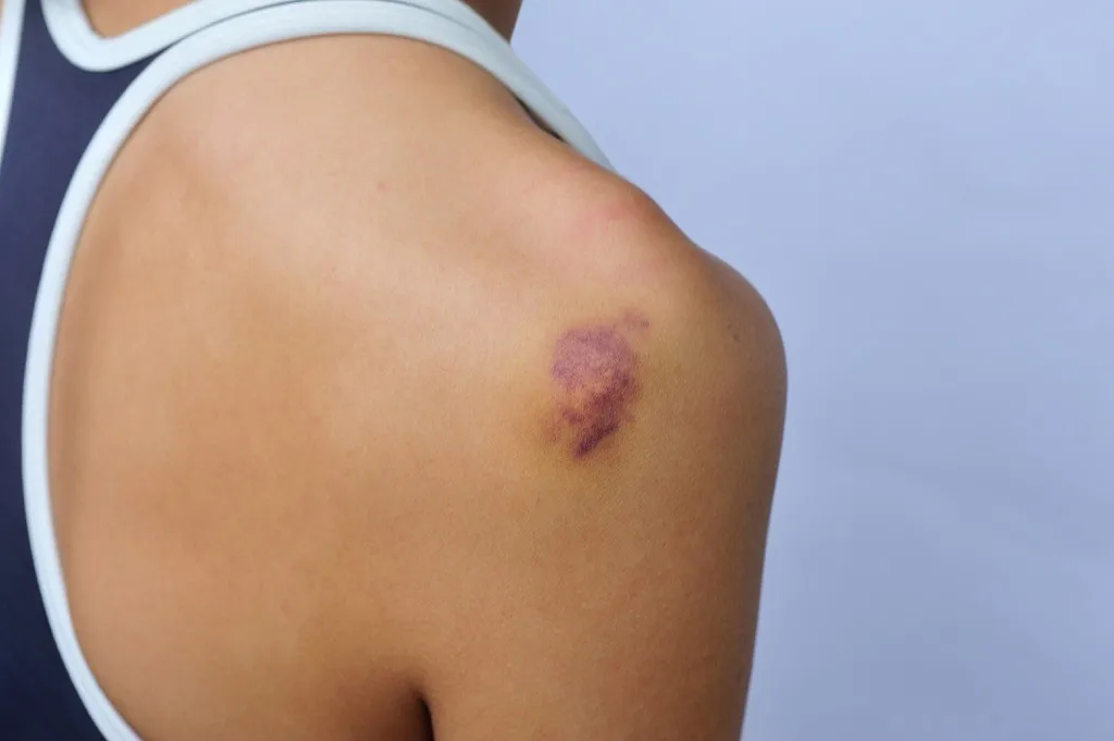 bruise on a woman's shoulder