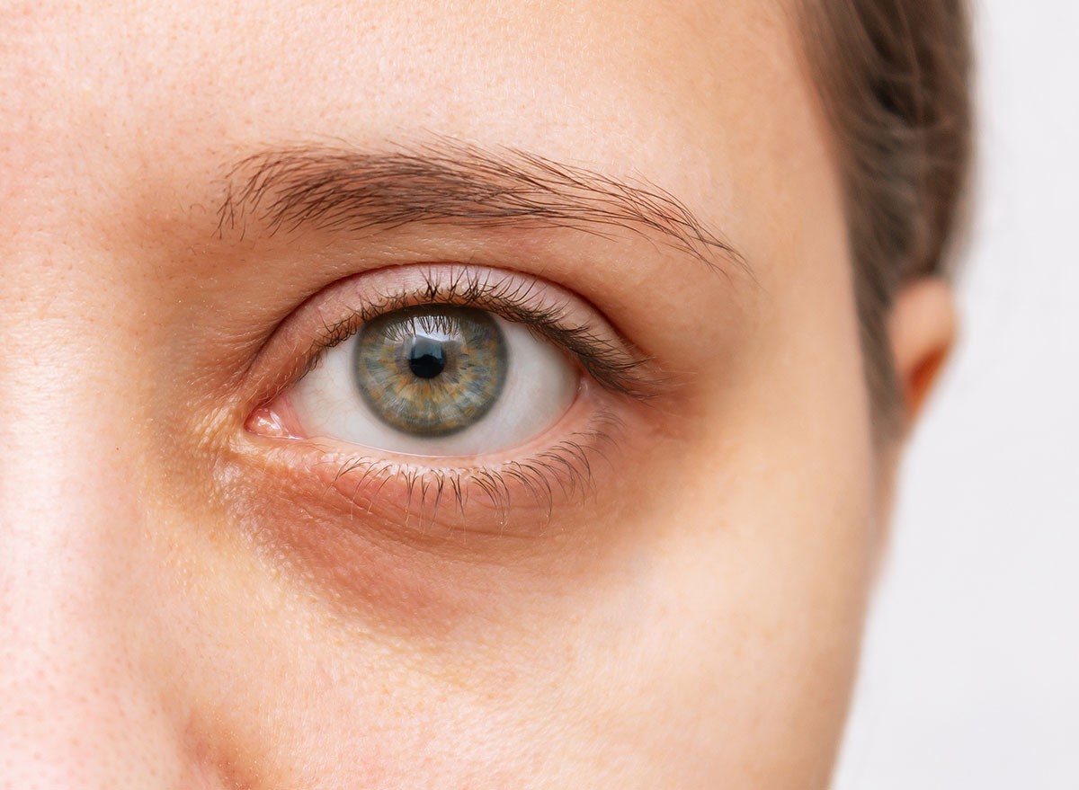 Dermatologists Share the Best At-Home Hacks to Reduce Dark Circles