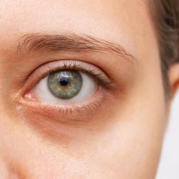 Dermatologists Share the Best At-Home Hacks to Reduce Dark Circles