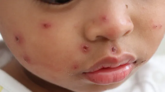 Measles Outbreak May Be Sign of Things To Come, Per Study