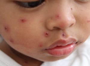 Measles Outbreak May Be Sign of Things To Come, Per Study