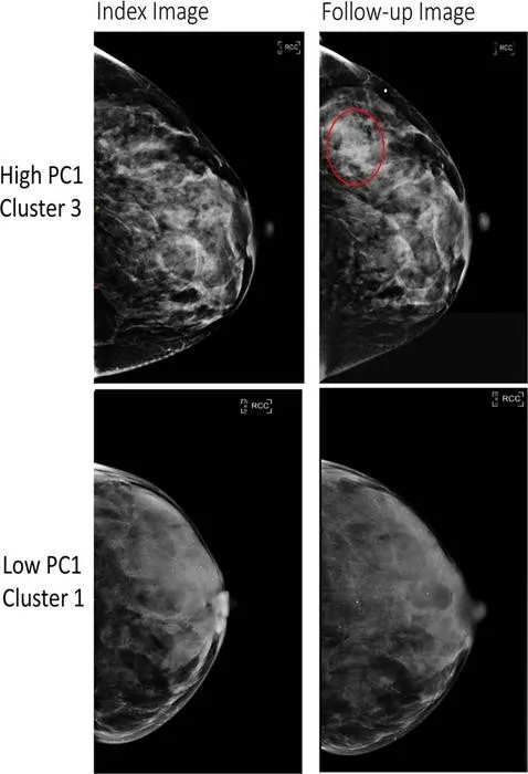 A high-risk phenotype breast tissue pattern (top) and a low-risk phenotype (bottom)